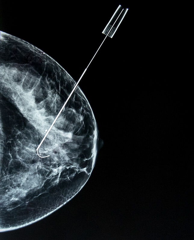 Medical image of a biopsy needle being inserted into a breast.