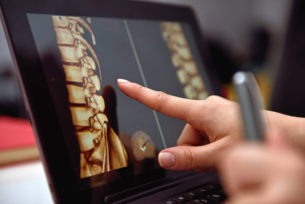 Doctor looks at an image of a patient’s spine on a computer screen.