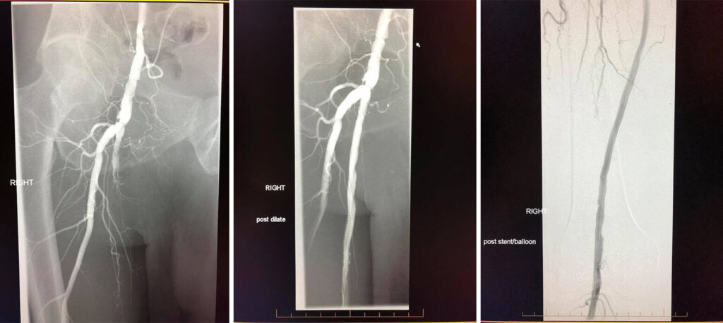 angiogram scan of the right superficial femoral artery